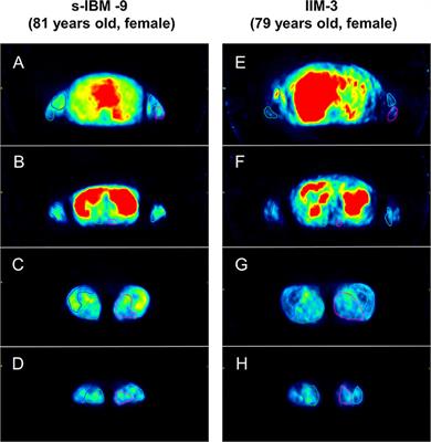 Diagnostic Value of Muscle [11C] PIB-PET in Inclusion Body Myositis